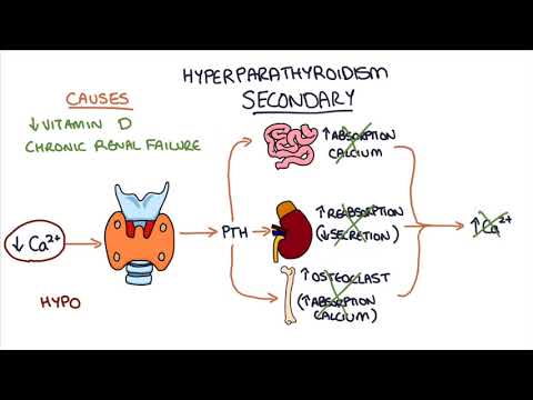 Understanding Hyperparathyroidism