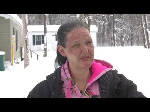 Woman warns others about mistake that left her badly burned