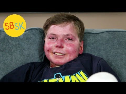 Living in a Body of Open Wounds with Less than Half His Skin (John Hudson - Epidermolysis Bullosa)