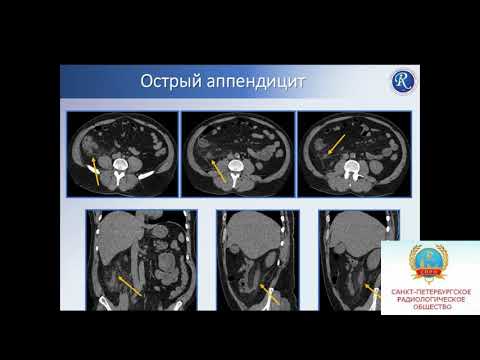 Кудрявцева А.В. «КТ диагностики острых заболеваний живота»