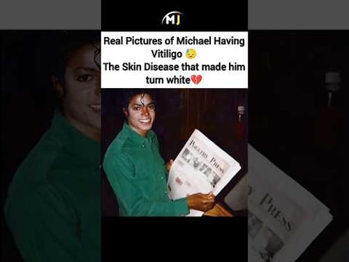 Michael Jackson on his Skin Condition Vitiligo