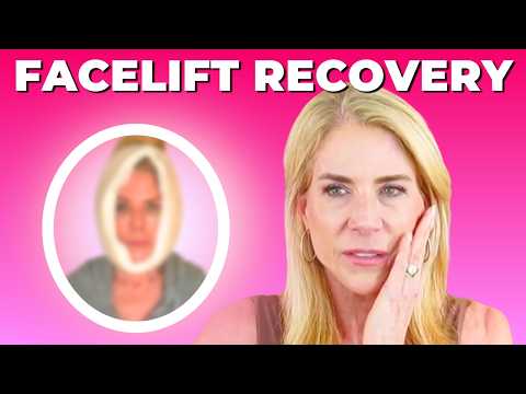 Before You Get a Facelift, Watch This: What I Wish I’d Known