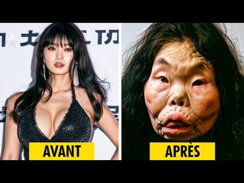 20 Ratés De Chirurgie Esthétique Chez Les Célébrités