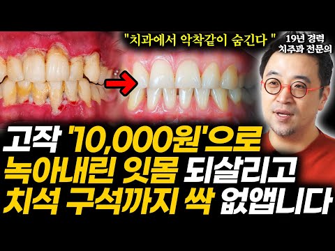 "죽은 잇몸도 살아난다" 19년 치과의사의 무덤까지 갖고 갈 1급 비밀 공개. 피나고 뿌리째 녹아버린 잇몸병 없애는 가장 손쉬운 방법 (박정철 원장 1부)