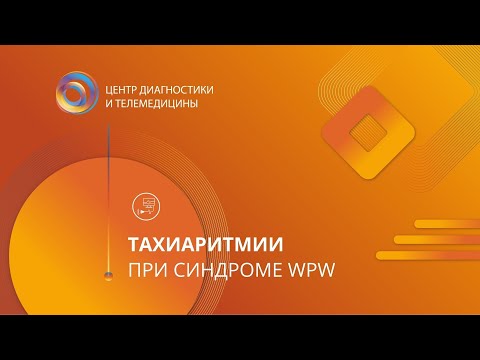 Тахиаритмии при синдроме WPW