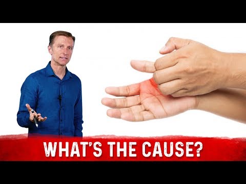 What Causes Sweaty / Dry Hands & How To Get Rid Of It? – Dr. Berg