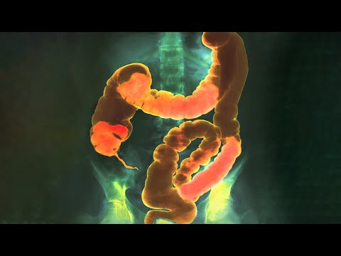 A Man Ate 20 Protein Bars Everyday And It Ruined His Life