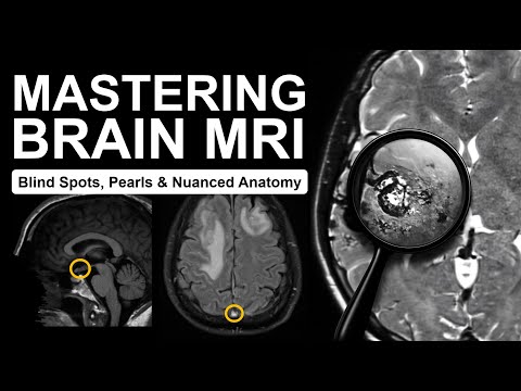 Mastering Brain MRI: Blind Spots, Pearls & Nuanced Anatomy