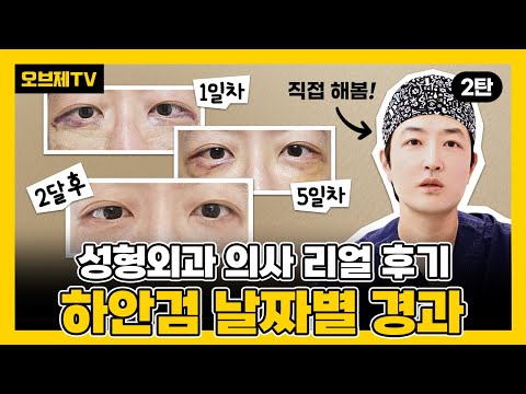 성형외과전문의 하안검 수술받다! 성형외과전문의가 직접 경험한 생생한 후기 2탄! | 눈성형, 증상, 부작용, 하안검, 눈밑지방재배치 | 오브제성형외과 장욱 원장