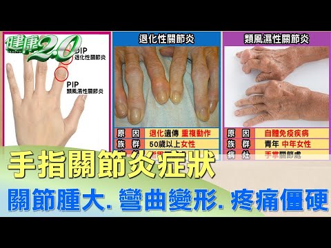 手指關節炎症狀!關節腫大.彎曲變形.疼痛僵硬 健康2.0