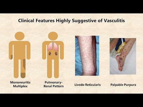 Vasculitis - An Overview