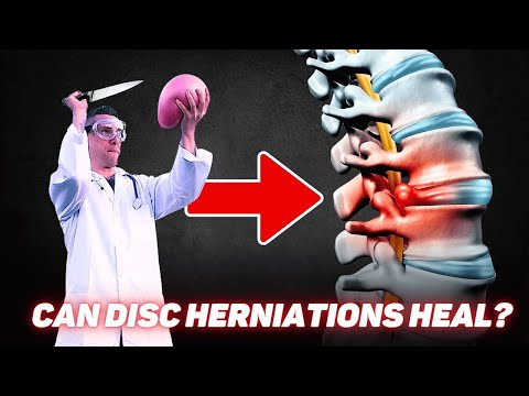 Disc Herniation Recovery Time - How Long To Heal LOW BACK PAIN & SCIATICA?