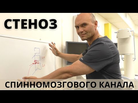 СТЕНОЗ СПИННОМОЗГОВОГО КАНАЛА ПОЗВОНОЧНИКА: тревожные симптомы и лечение