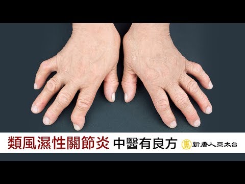 長期關節疼痛? 改善「類風濕性關節炎」中醫有良方
