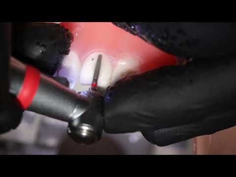 STOMBUDNI#56 Only 2 burs for crown preparation!