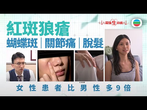 最強生命線|紅斑狼瘡可致嚴重併發症 女性患者比男性多9倍(繁 / 簡字幕)|醫療|治療|無綫新聞|TVB News