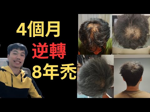 I reversed 8-year bald in 4 months (English Subtitle, filmed 2024.12.09)