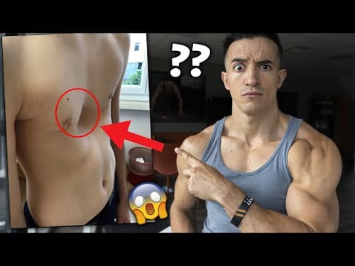 UN TROU DANS LES PECTORAUX ?? (pectus excavatum)