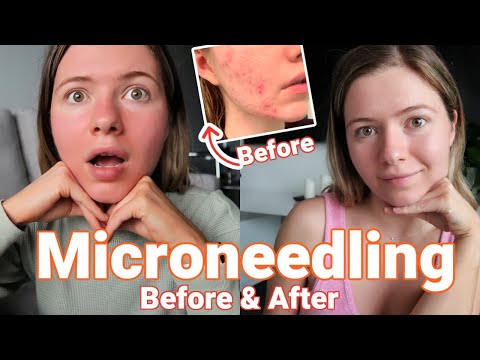 All About Microneedling (Vlog) | Before, After and Everything in Between (Healing Post-Acne Skin)