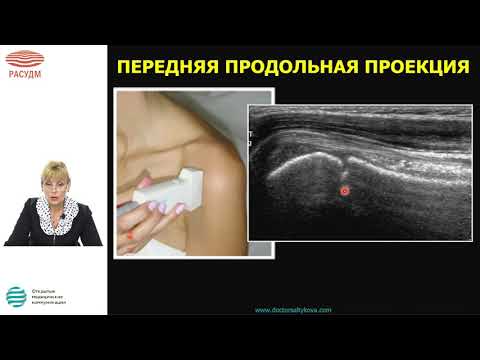 Алгоритм УЗИ плечевого сустава. Стандарты сканирования. Диагностика острой травмы плечевого сустава