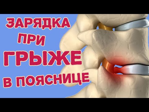 Exercises for a lumbar disc herniation. Physical therapy exercises for extrusion and protrusion.