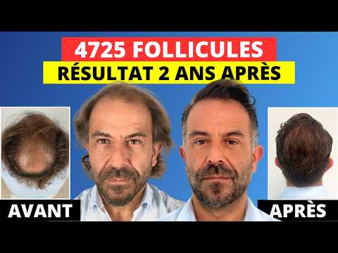 Ma greffe de cheveux est la plus réussie de toutes ! Le résultat en Images 📹