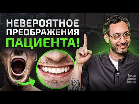 Что делать при полном отсутствии зубов? Невероятное преображение пациента!