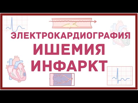 ЭКГ - инфаркт и ишемия