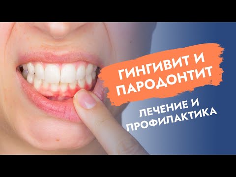 Гингивит и пародонтит. Лечение и профилактика.