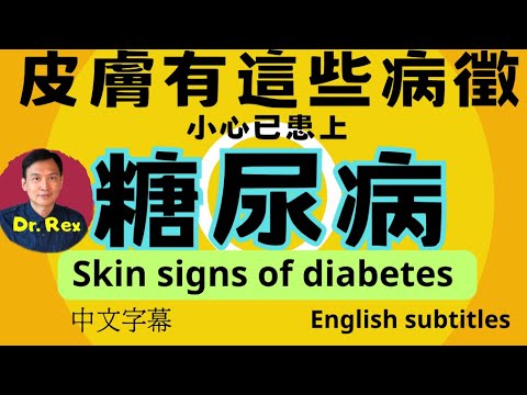 留意這些糖尿病的皮膚徵狀!skin signs of diabetes