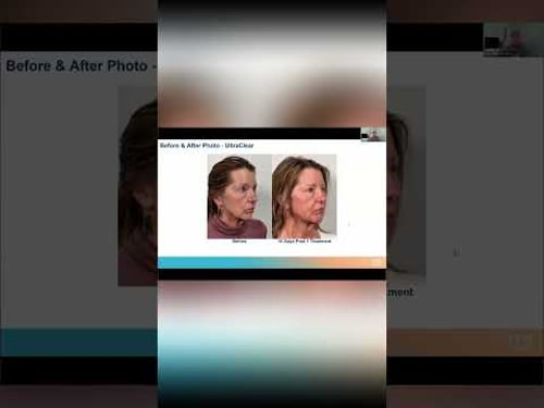 6 Weeks Post-UltraClear: My Skin Looks FABULOUS! #shorts