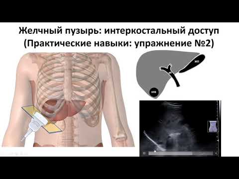 Ультразвуковая анатомия желчного пузыря и желчевыводящих путей