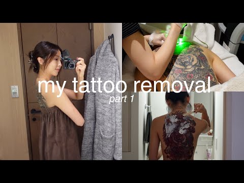 【Tattoo Removal】The beginning of my tattoo removal journey.
