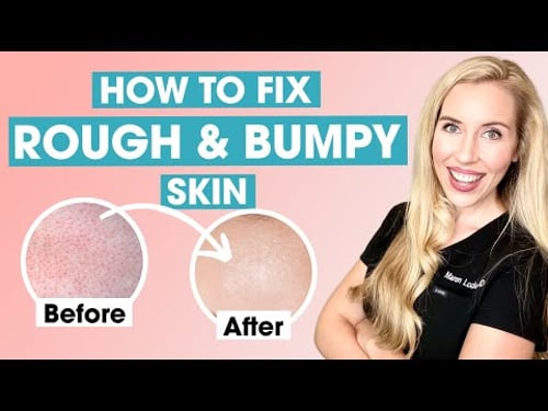How To Fix Rough and Bumpy Skin | Keratosis Pilaris Affordable Skincare Routine