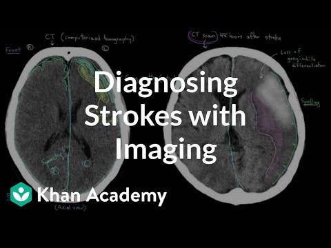 Diagnosing strokes with imaging CT, MRI, and Angiography | NCLEX-RN | Khan Academy