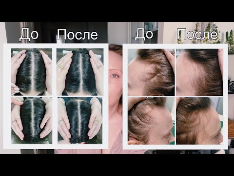 Hair is falling out. And I am treating it. Visit to a trichologist. Trichoscopy. Therapy