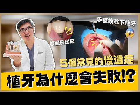 【植牙 #11】植牙為什麼會失敗?植牙失敗後該怎麼辦〈上〉 解析植牙失敗的6大原因&5種常見的後遺症|【祐民牙醫-隱適美旗艦店】鑽石級楊大為醫師 #植體周圍炎 #齒槽骨流失 #植牙後遺症 #植牙