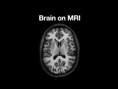 Anatomy of the Brain on MRI