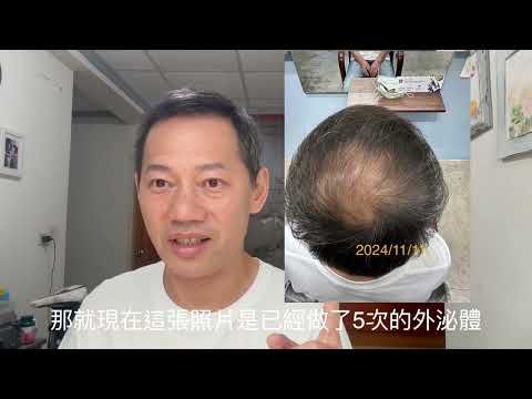 兩種不同方式治療雄禿過程紀錄(期間2024到2025)