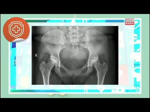 精靈一點:髖關節常見疾病